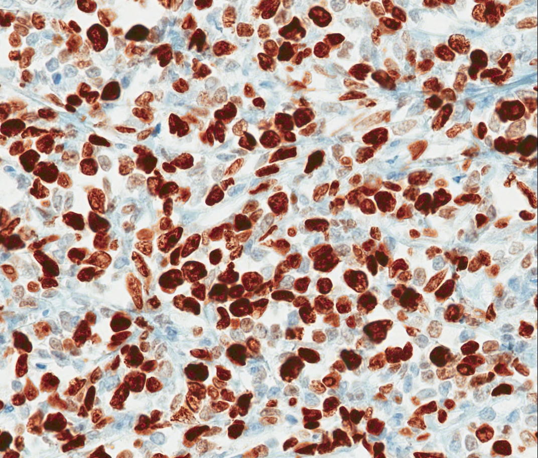 Mediastinal Mass Ki-67 40x